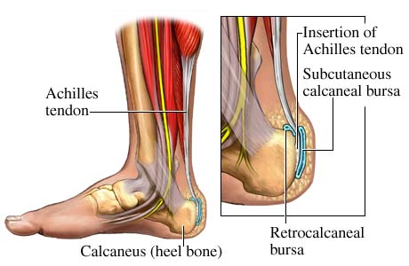 Achilles Tendonitis